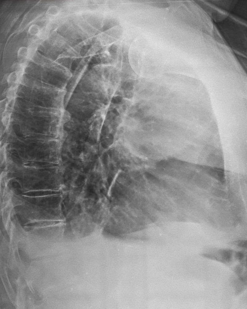 Torace in proiezione laterale, qualità Cipriani: vertebre dorsali e trama polmonare ben definite