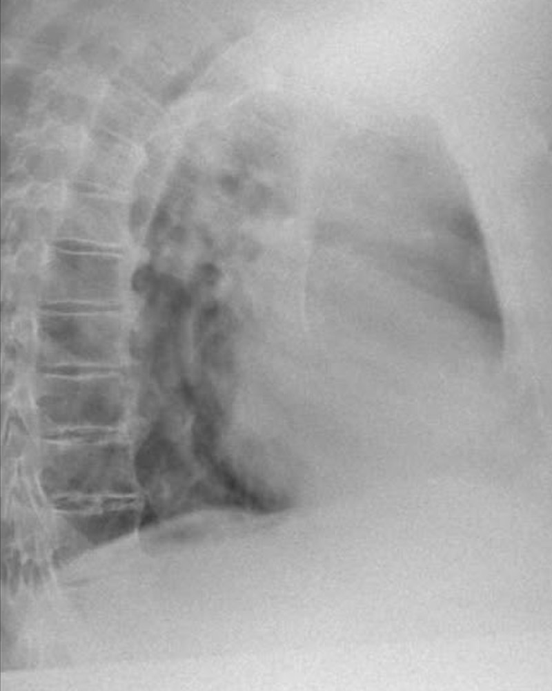 Torace in proiezione laterale, qualità standard: immagine velata e poco contrastata, vertebre e polmoni poco leggibili