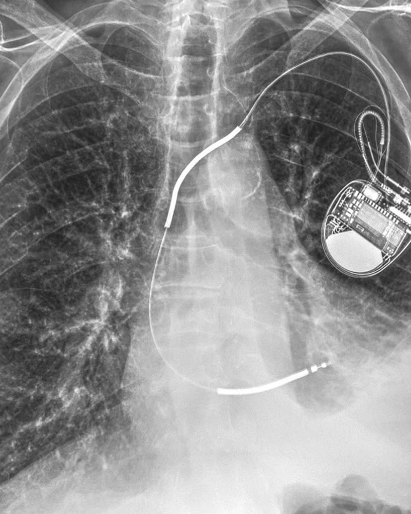 Torace con pacemaker, qualità Cipriani: polmoni, coste, pacemaker ed elettrocateteri ben definiti