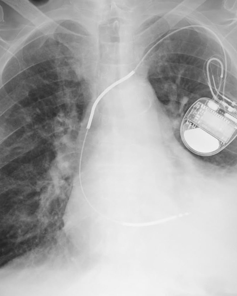 Torace con pacemaker, qualità standard: immagine velata, polmoni poco leggibili
