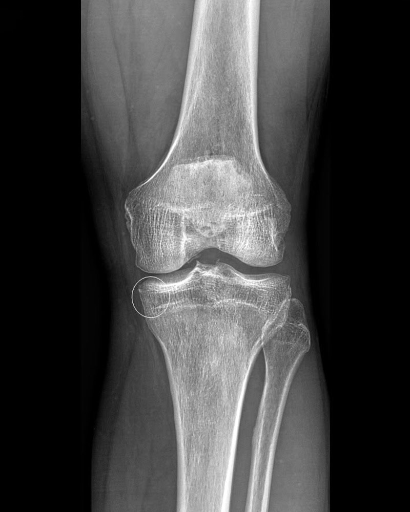 Radiografia al ginocchio