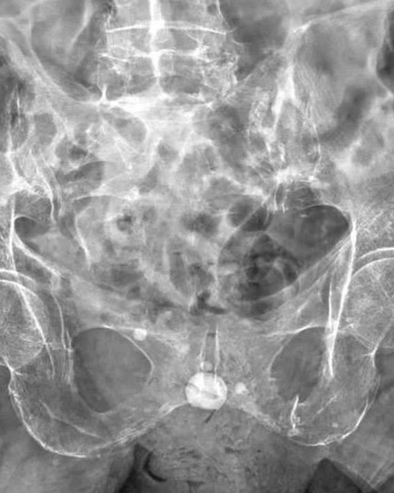 Bacino, qualità Cipriani: ossa del bacino e anche ben contrastate, struttura ossea nitida