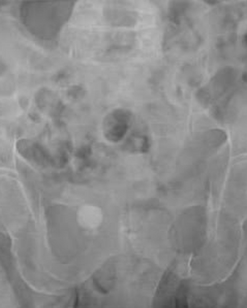 Bacino, qualità standard: immagine grigia e poco contrastata, contorni delle ossa poco definiti